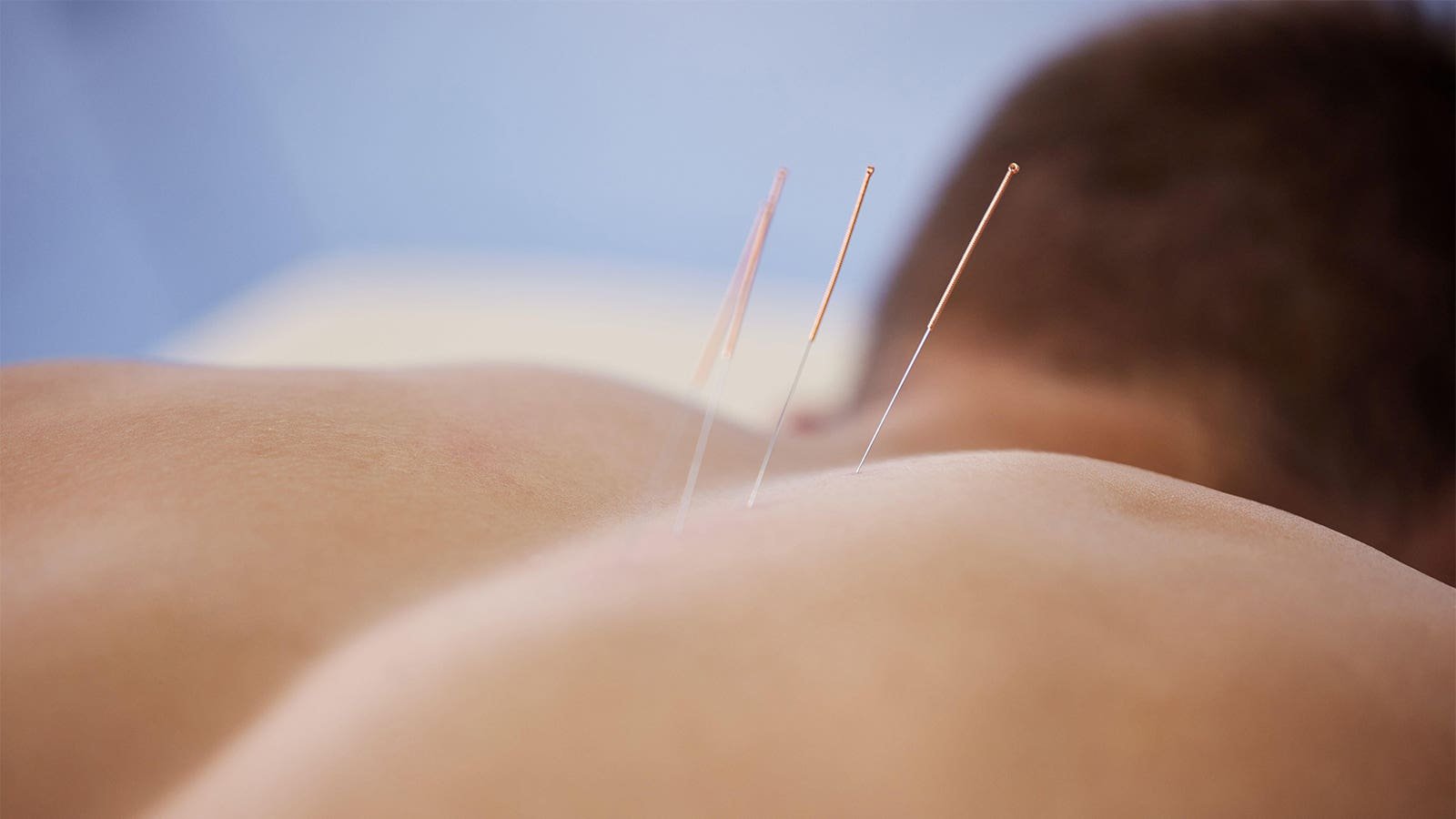 Acupuncture helps alleviate PTSD in veterans