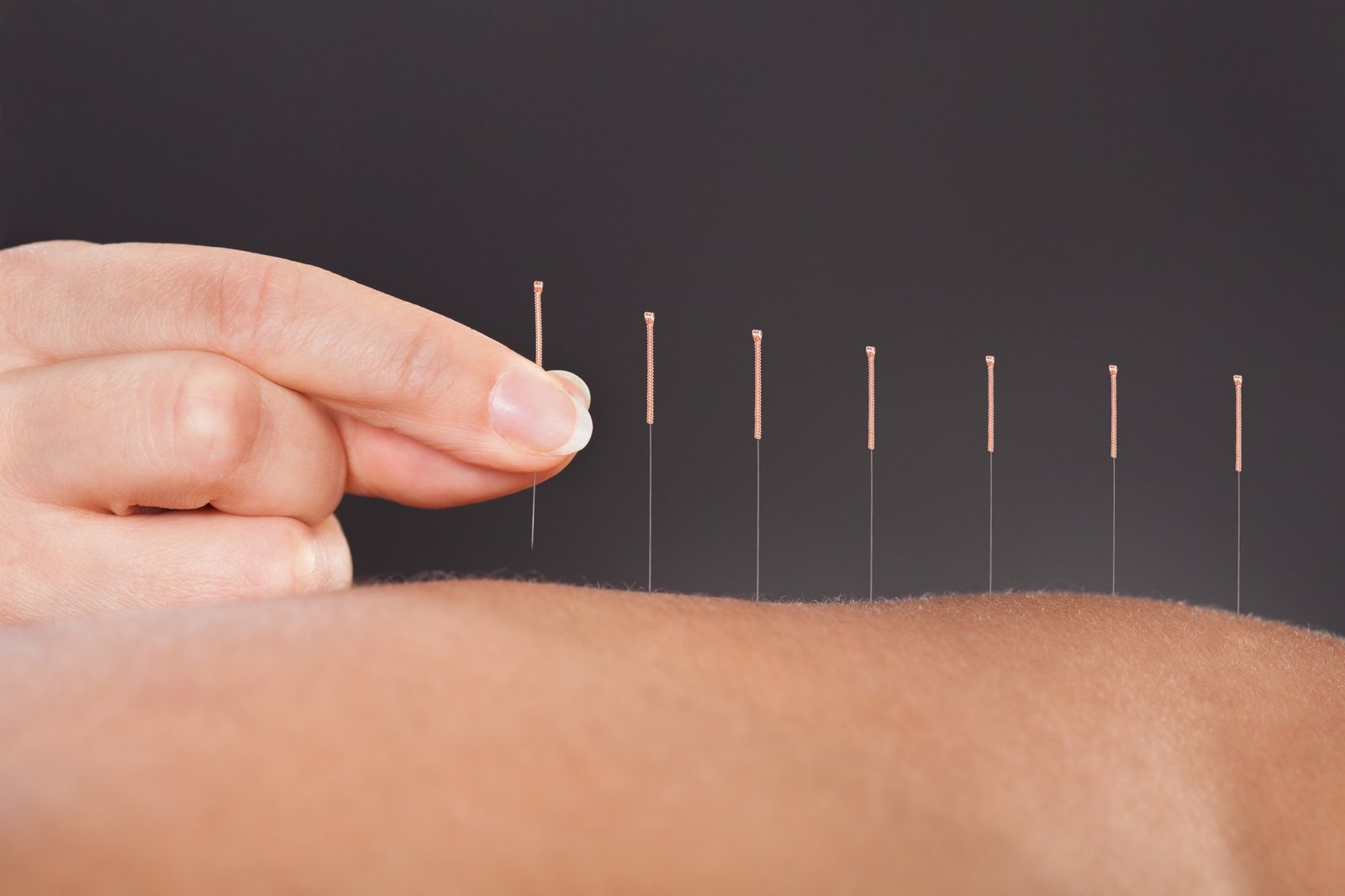 Acupuncture is beneficial in reducing the incidence of ischemic stroke