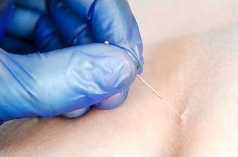 Who wins? PT vs. dry needling showdown
