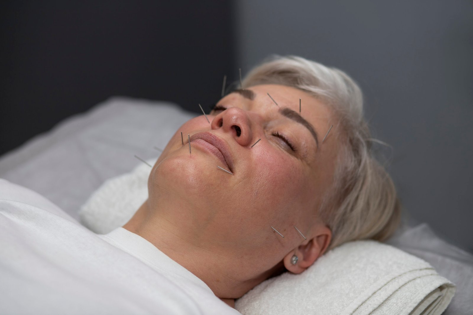 Is facial acupuncture the new Botox?