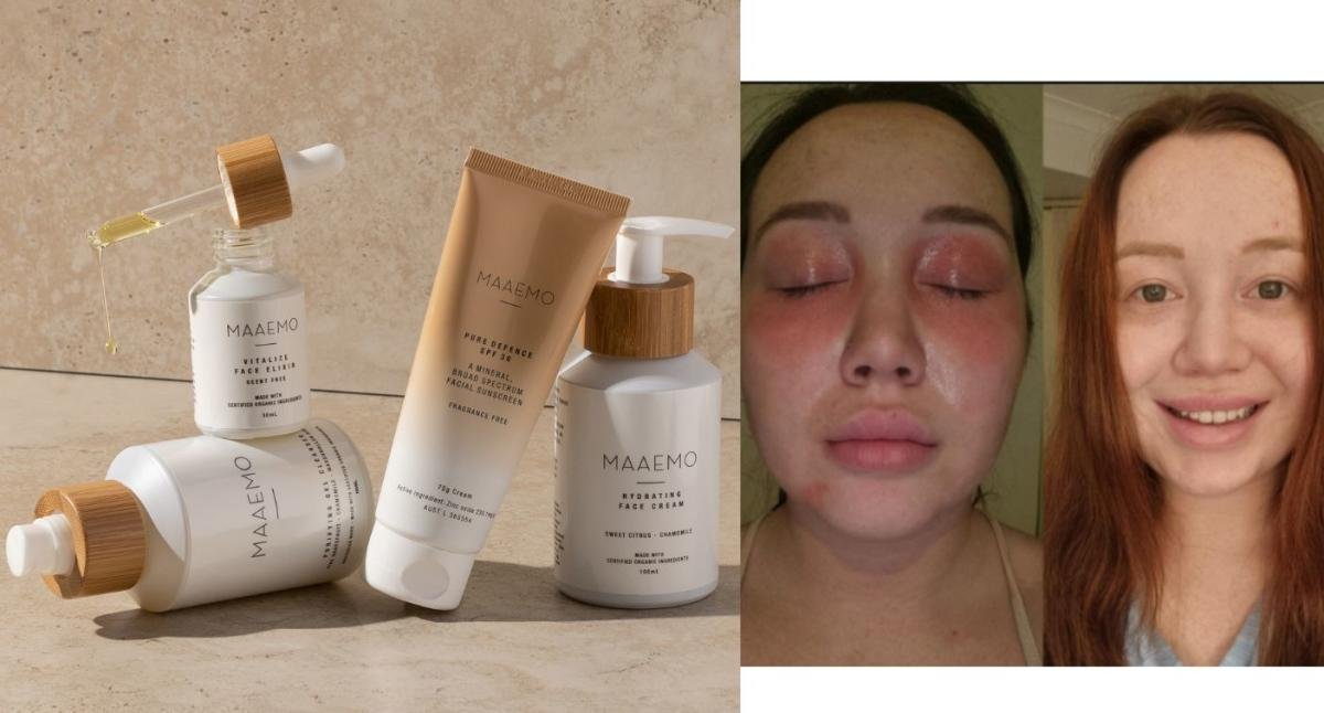 Natural skin care products to treat acne: “It’s changed my life”