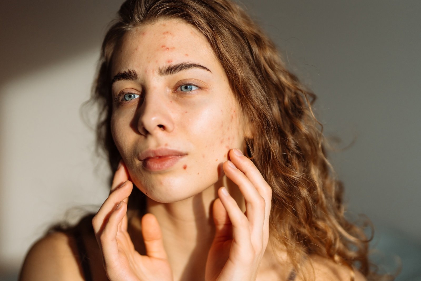 Effects of diet and nutrition on acne vulgaris