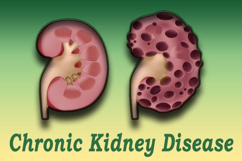 Clinical nutrition market for chronic kidney disease is growing