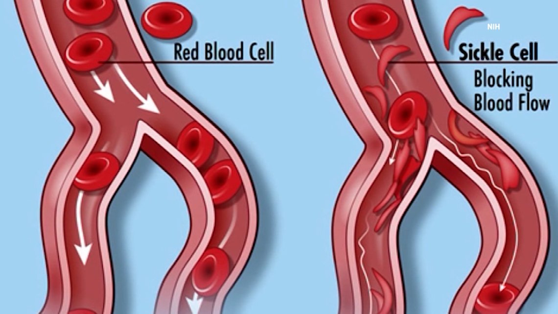 World Sickle Cell Awareness Day